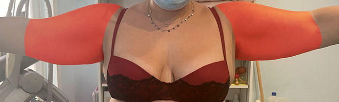Il tipo di lipedema