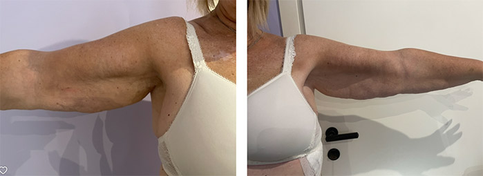 Il tipo di lipedema