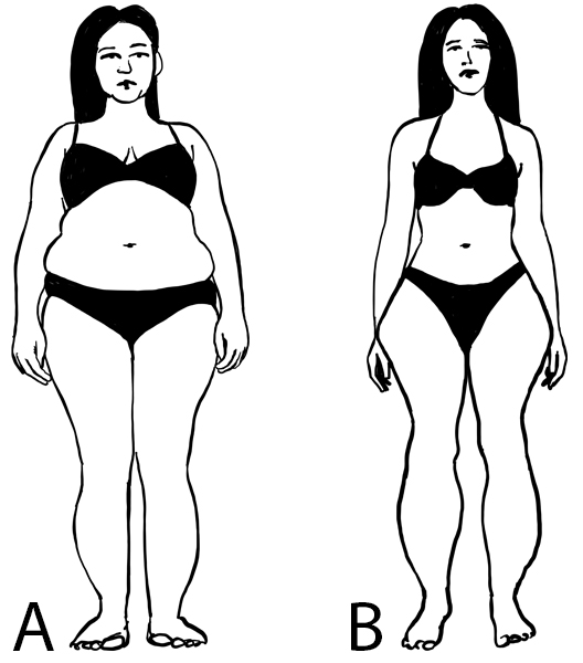 Differenze tra obesità e lipedema in una donna