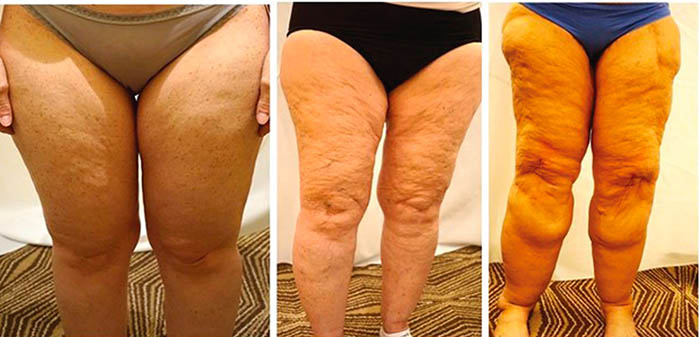 Il trattamento del lipedema e del grasso delle gambe a Milano