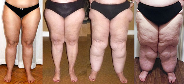 Il trattamento del lipedema e del grasso delle gambe a Milano