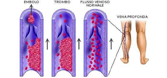 La trombosi venosa profonda