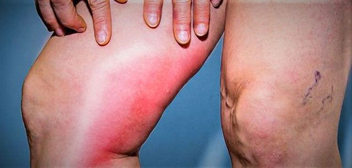 La tromboflebite
ddd