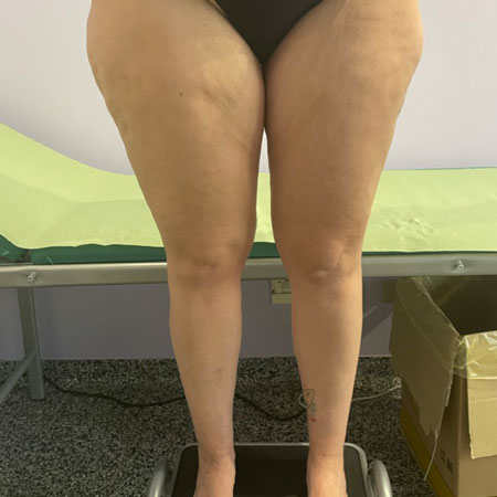 Gambe gonfie e dolenti in gravidanza
