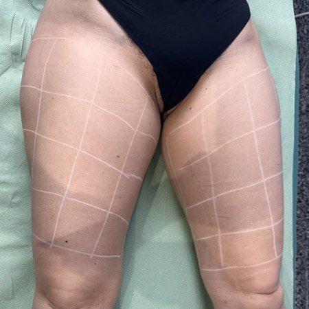 Trattamento anti-cellulite a Milano