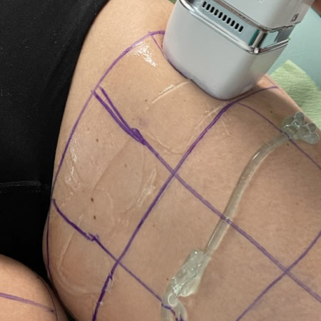 Trattamento anti-cellulite a Milano