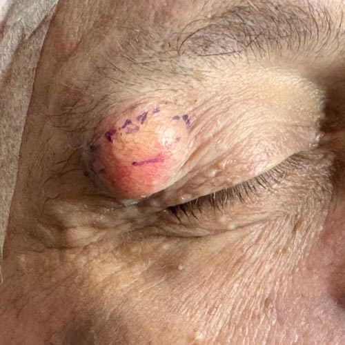 Cisti sebacea della palpebra pronta per essere rimossa