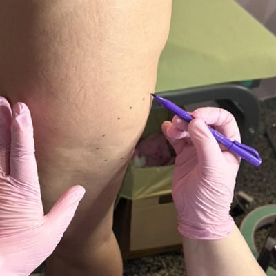 Chirurgo Vascolare Cura delle Vene Varicose a Milano