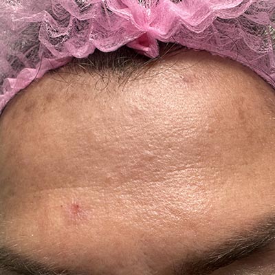 Rimozione delle macchie solari con penna al plasma