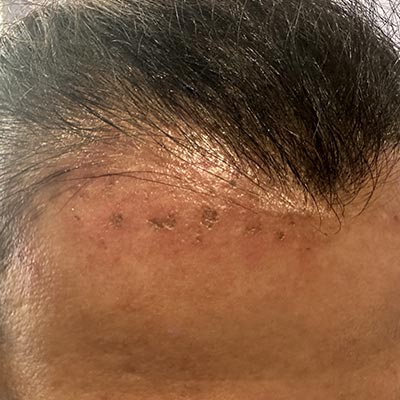 Rimozione delle macchie solari con penna al plasma