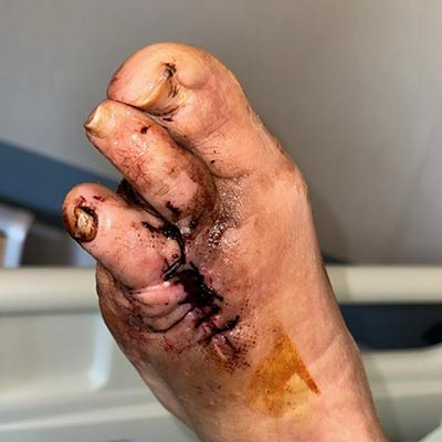 Medico Vulnologo cura del piedediabetico a Milano