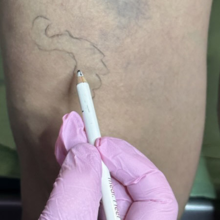 Chirurgo Vascolare Cura delle Vene Varicose a Milano